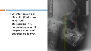 CF: intersección del plano FH (Po-Or) con la vertical pterigoidea  PTV (perpendicular a FH tangente a la pared posterior de la FPM) 