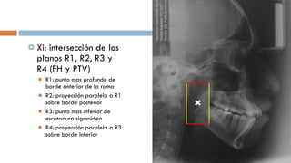 Xi: intersección de los planos R1, R2, R3 y R4 (FH y PTV) R1: punto mas profundo de borde anterior de la rama R2: proyección paralela a R1 sobre borde posterior R3: punto mas inferior de escotadura sigmoidea R4: proyección paralela a R3 sobre borde inferior 