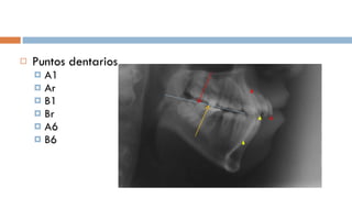 Puntos dentarios A1  Ar B1 Br A6 B6 