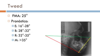 Analisis de tweed | PPT