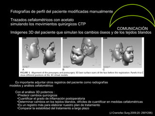 COMUNICACIÓN
(J Craniofac Surg 2009;20: 290Y296)
Es importante adjuntar otros registros del paciente como radiografías
modelos y análisis cefalométrico
Con el análisis 3D podemos :
•Predecir cambios quirúrgicos
•Cuantificar el grado de inflamación postoperatoria
•Determinar cambios en los tejidos blandos, difíciles de cuantificar en medidas cefalométricas
•Es un registro más para elaborar nuestro plan de tratamiento
•Comparar la estabilidad del tratamiento a largo plazo
Fotografías de perfil del paciente modificadas manualmente
Trazados cefalométricos con acetato
simulando los movimientos quirúrgicos CTP
Imágenes 3D del paciente que simulan los cambios óseos y de los tejidos blandos
 