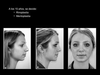A los 15 años, se decide:
• Rinoplastia
• Mentoplastia
 