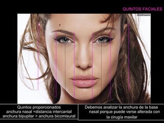 QUINTOS FACIALES
Quintos proporcionados
anchura nasal =distancia intercantal
anchura bipupilar > anchura bicomisural
Debemos analizar la anchura de la base
nasal porque puede verse alterada con
la cirugía maxilar
 