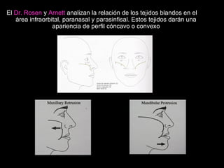 El Dr. Rosen y Arnett analizan la relación de los tejidos blandos en el
área infraorbital, paranasal y parasinfisal. Estos tejidos darán una
apariencia de perfil cóncavo o convexo
Arnett
 