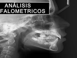 ANÁLISIS
FALOMETRICOS
 