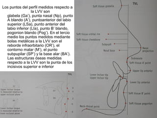 4. PROYECCIONES A LLV
Los puntos del perfil medidos respecto a
la LVV son
glabela (Ga’), punta nasal (Np), punto
A blando (A’), puntoanterior del labio
superior (LSa), punto anterior del
labio inferior (LIa), punto B’ blando,
pogonion blando (Pog’). En el tercio
medio los puntos medidos mediante
bolas metálicas a la LVV son el
reborde infraorbitario (OR’), el
contorno malar (M’), el punto
subpupilar (SP’) y la base alar (BA’).
Las estructuras óseas medidas
respecto a la LVV son la punta de los
incisivos superior e inferior
 