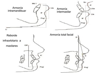 5. VALORES DE LA ARMONÍA
Armonía
intramandibuar
Armonía
intermaxilar
Reborde
infraorbitario a
maxilares
Armonía total facial
 