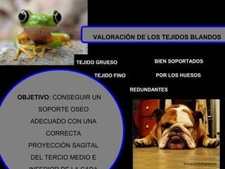 •
VALORACIÓN DE LOS TEJIDOS BLANDOS
TEJIDO GRUESO
TEJIDO FINO
REDUNDANTES
BIEN SOPORTADOS
POR LOS HUESOS
OBJETIVO: CONSEGUIR UN
SOPORTE OSEO
ADECUADO CON UNA
CORRECTA
PROYECCIÓN SAGITAL
DEL TERCIO MEDIO E
 