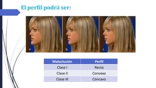 El perfil podrá ser:
Maloclusión Perfil
Clase I Recto
Clase II Convexo
Clase III Cóncavo
 