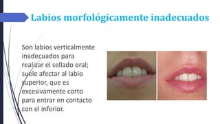 Labios morfológicamente inadecuados
Son labios verticalmente
inadecuados para
realizar el sellado oral;
suele afectar al labio
superior, que es
excesivamente corto
para entrar en contacto
con el inferior.
 