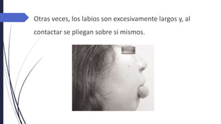 Otras veces, los labios son excesivamente largos y, al
contactar se pliegan sobre si mismos.
 
