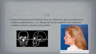 
 Línea horizontal de Frankfort: línea de referencia que es usado en el
análisis cefalometrico, y se dibuja del borde superior del conducto
auditivo externo a borde infraorbital.
 