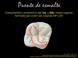 Puente de esmalte
Característica anatómica del 1ro. y 2do. molar superior
formado por unión de cúspide MP y DV
Anatomía, fisiología y oclusión dentales de Wheeler; editorial Interamerican McGraw-Hill: capitulo 6
Photo: BoneBox - Dental Lite
Desafiando la Naturales, Paulo kano; editorial Quintessence; capitulo 1 y 2
 
