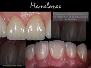 Mamelones
Protuberancias redondeadas que
se encuentran en el borde incisal
de incisivos
Photo cortesía: Dr. Norbert Puello
 