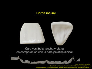 Borde incisal
Cara vestibular ancha y plana
en comparación con la cara palatina incisal
Anatomía, fisiología y oclusión dentales de Wheeler; editorial Interamerican McGraw-Hill: capitulo 6
Photo: BoneBox - Dental Lite
Desafiando la Naturales, Paulo kano; editorial Quintessence; capitulo 1 y 2
 