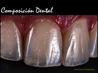 Composición Dental
Photo cortesía: Dr. Norbert Puello
 