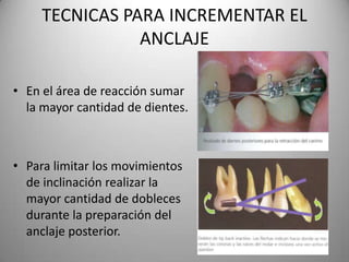TECNICAS PARA INCREMENTAR EL
ANCLAJE
• En el área de reacción sumar
la mayor cantidad de dientes.

• Para limitar los movimientos
de inclinación realizar la
mayor cantidad de dobleces
durante la preparación del
anclaje posterior.

 