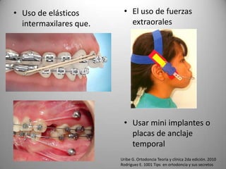 • Uso de elásticos
intermaxilares que.

• El uso de fuerzas
extraorales

• Usar mini implantes o
placas de anclaje
temporal
Uribe G. Ortodoncia Teoría y clínica 2da edición. 2010
Rodriguez E. 1001 Tips en ortodoncia y sus secretos

 