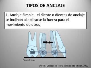 TIPOS DE ANCLAJE
1. Anclaje Simple.- el diente o dientes de anclaje
se inclinan al aplicarse la fuerza para el
movimiento de otros

Plano Oclusal
Uribe G. Ortodoncia Teoría y clínica 2da edición. 2010

 