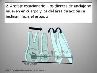 2. Anclaje estacionario.- los dientes de anclaje se
mueven en cuerpo y los del área de acción se
inclinan hacia el espacio

Plano Oclusal
Uribe G. Ortodoncia Teoría y clínica 2da edición. 2010

 