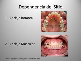 Dependencia del Sitio
1. Anclaje Intraoral

2. Anclaje Muscular

Uribe G. Ortodoncia Teoría y clínica 2da edición. 2010

 