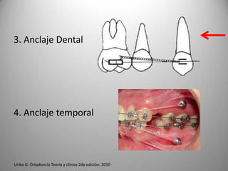 3. Anclaje Dental

4. Anclaje temporal

Uribe G. Ortodoncia Teoría y clínica 2da edición. 2010

 