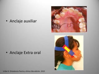 • Anclaje auxiliar

• Anclaje Extra oral

Uribe G. Ortodoncia Teoría y clínica 2da edición. 2010

 
