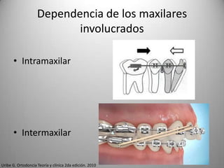 Dependencia de los maxilares
involucrados
• Intramaxilar

• Intermaxilar

Uribe G. Ortodoncia Teoría y clínica 2da edición. 2010

 