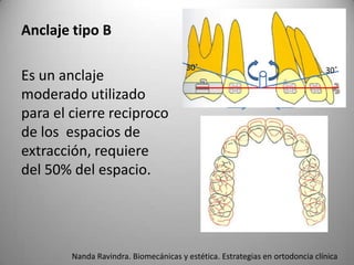 Anclaje tipo B
Es un anclaje
moderado utilizado
para el cierre reciproco
de los espacios de
extracción, requiere
del 50% del espacio.

30˚

30˚

Nanda Ravindra. Biomecánicas y estética. Estrategias en ortodoncia clínica

 