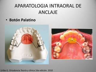 APARATOLOGIA INTRAORAL DE
ANCLAJE
• Botón Palatino

Uribe G. Ortodoncia Teoría y clínica 2da edición. 2010

 