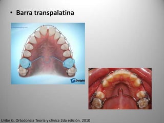 • Barra transpalatina

Uribe G. Ortodoncia Teoría y clínica 2da edición. 2010

 