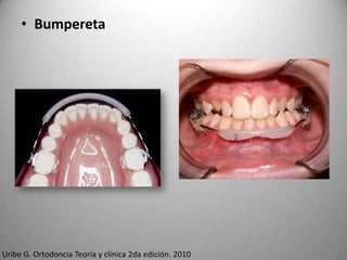 • Bumpereta

Uribe G. Ortodoncia Teoría y clínica 2da edición. 2010

 