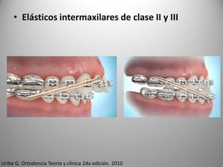 • Elásticos intermaxilares de clase II y III

Uribe G. Ortodoncia Teoría y clínica 2da edición. 2010

 