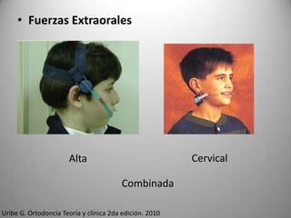 • Fuerzas Extraorales

Cervical

Alta
Combinada
Uribe G. Ortodoncia Teoría y clínica 2da edición. 2010

 