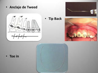 • Anclaje de Tweed

• Tip Back

• Toe in

 