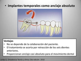 • Implantes temporales como anclaje absoluto

Ventajas
• No se depende de la colaboración del paciente.
• El tratamiento se acorta por retracción de los seis dientes
anteriores.
• Proporcionan anclaje casi absoluto para el movimiento dental
Uribe G. Ortodoncia Teoría y clínica 2da edición. 2010

 