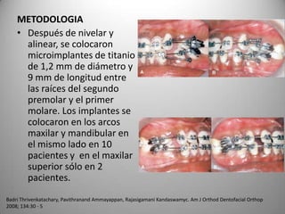 METODOLOGIA
• Después de nivelar y
alinear, se colocaron
microimplantes de titanio
de 1,2 mm de diámetro y
9 mm de longitud entre
las raíces del segundo
premolar y el primer
molare. Los implantes se
colocaron en los arcos
maxilar y mandibular en
el mismo lado en 10
pacientes y en el maxilar
superior sólo en 2
pacientes.
Badri Thrivenkatachary, Pavithranand Ammayappan, Rajasigamani Kandaswamyc. Am J Orthod Dentofacial Orthop
2008; 134:30 - 5

 