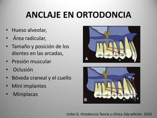 ANCLAJE EN ORTODONCIA
• Hueso alveolar,
• Área radicular,
• Tamaño y posición de los
dientes en las arcadas,
• Presión muscular
• Oclusión
• Bóveda craneal y el cuello
• Mini implantes
• Miniplacas

Uribe G. Ortodoncia Teoría y clínica 2da edición. 2010

 