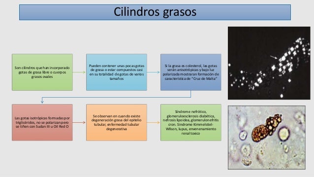 Gotas De Grasa En Sedimento Urinario www.slideshare.net