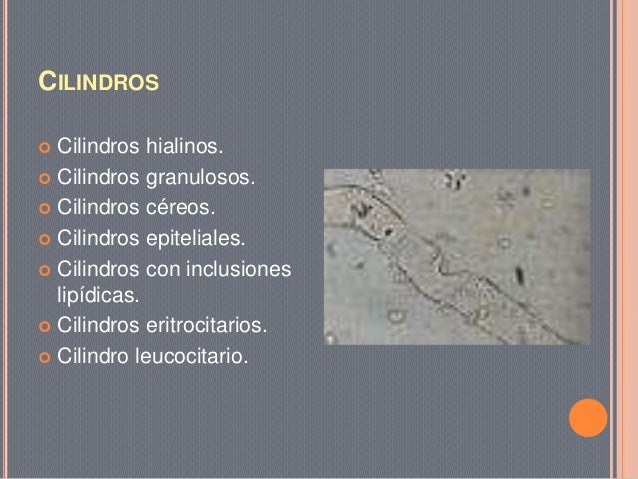 Resultado de imagen para analisis de orina cilindros de orina