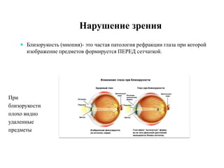  Близорукость (миопия)- это частая патология рефракции глаза при которой
изображение предметов формируется ПЕРЕД сетчаткой.
При
близорукости
плохо видно
удаленные
предметы
 
