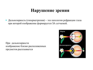  Дальнозоркость (гиперметропия) – это патология рефракции глаза
при которой изображение формируется ЗА сетчаткой.
При дальнозоркости
изображение близко расположенных
предметов расплывается
 
