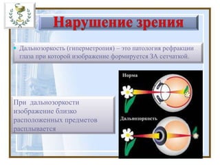  Дальнозоркость (гиперметропия) – это патология рефракции
глаза при которой изображение формируется ЗА сетчаткой.
При дальнозоркости
изображение близко
расположенных предметов
расплывается
 