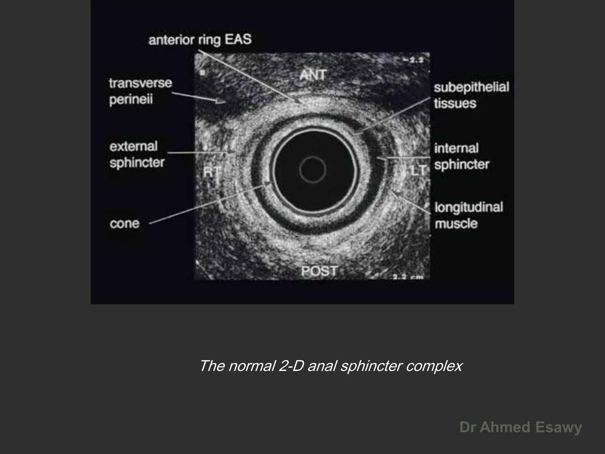 Anal perianal imaging part 1 CT MRI anatomy Dr Ahmed Esawy | PDF