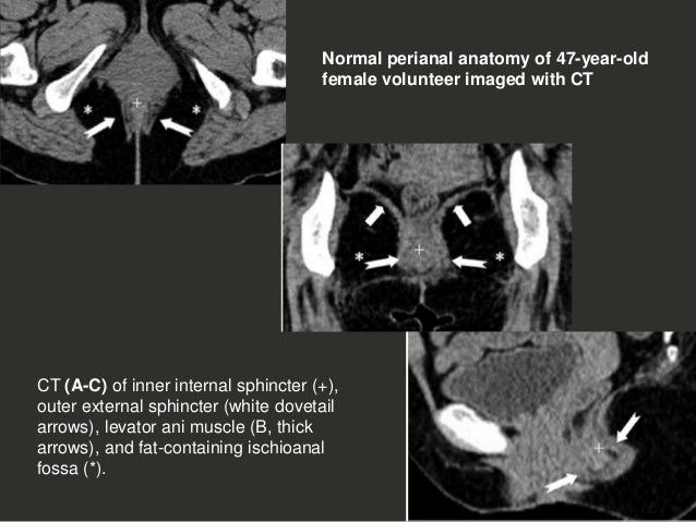 Anal Perianal Imaging Part 1 Ct Mri Anatomy Dr Ahmed Esawy