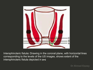 Anal perianal imaging part 2 perianal fistula CT MRI Dr Ahmed Esawy | PDF