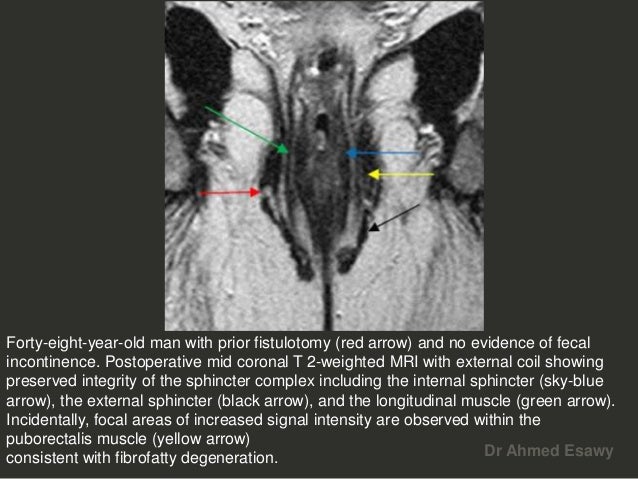 Anal Perianal Imaging Part 4 In Faecal Continence Ct Mri Dr Ahmed Esa…