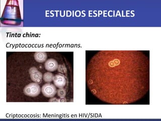 ESTUDIOS ESPECIALES

Tinta china:
Cryptococcus neoformans.




Criptococosis: Meningitis en HIV/SIDA
 