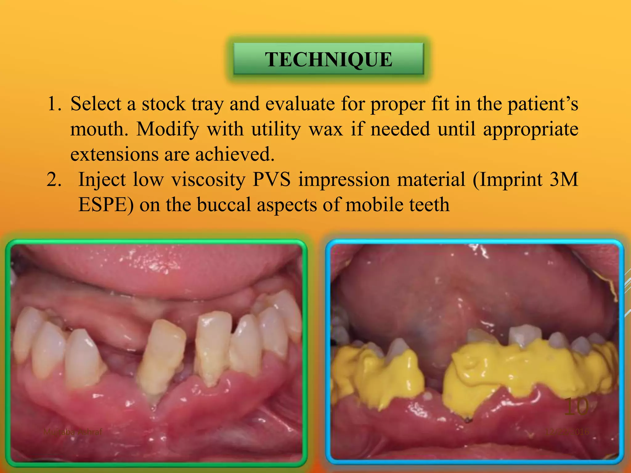 An alternative impression technique for mobile teeth | PPTX
