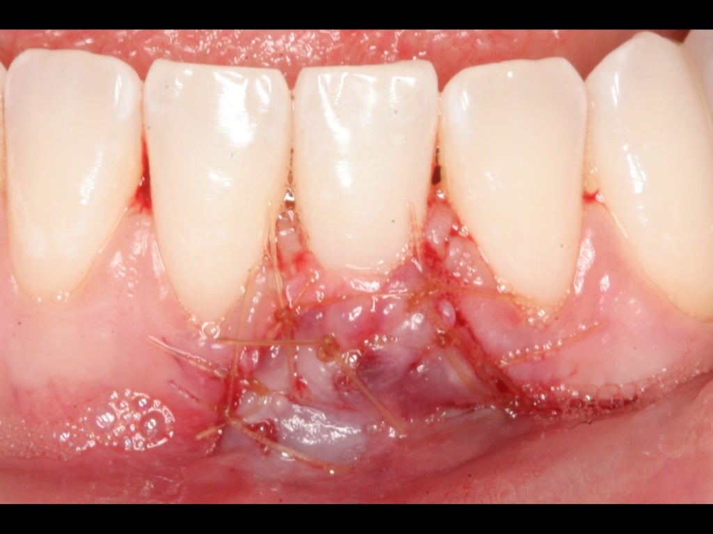 An Alternative to Autogenous Connective Tissue Grafting for Root Cove…